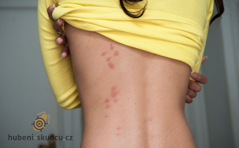 štípance od štěnice